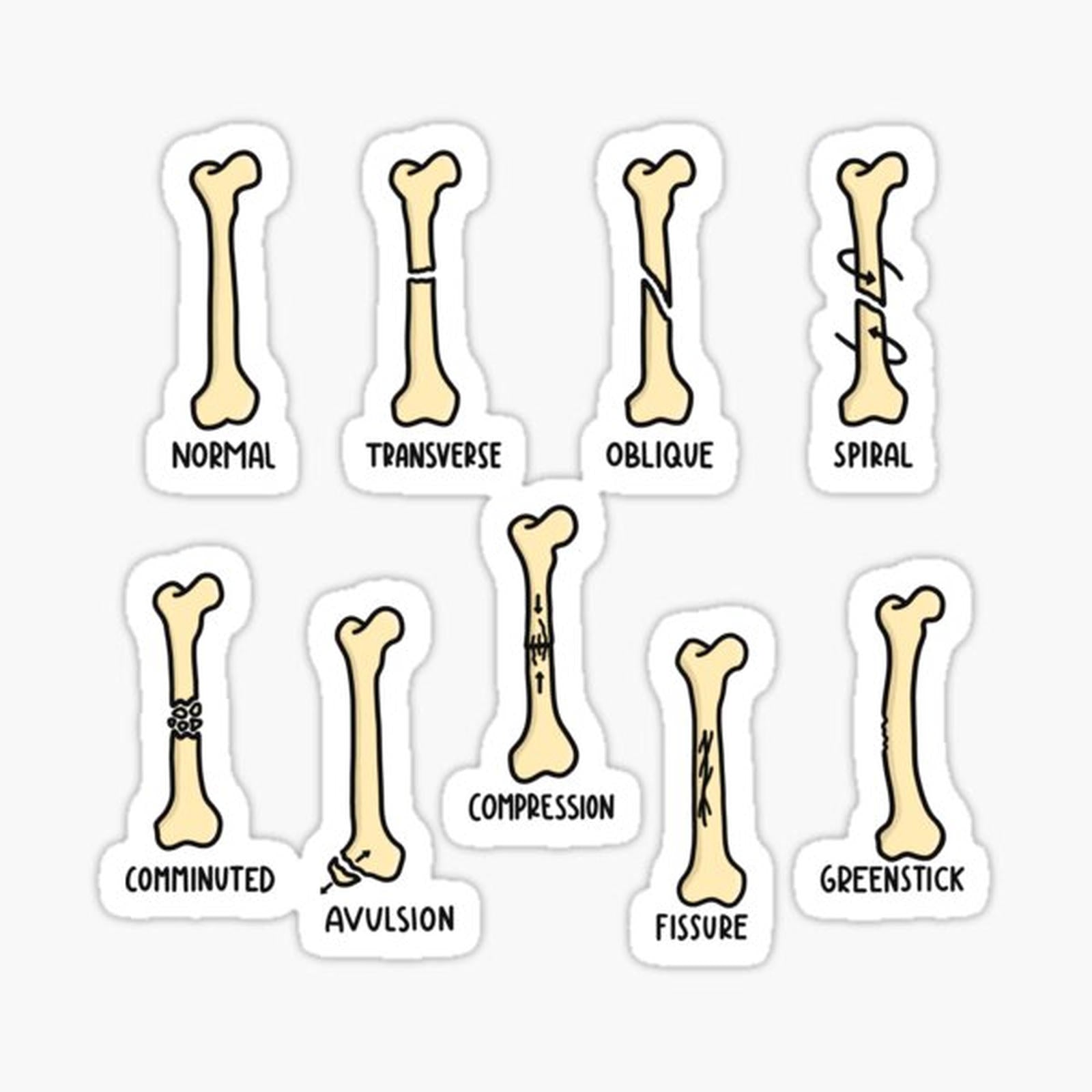 Hand Drawn Types of Fractures